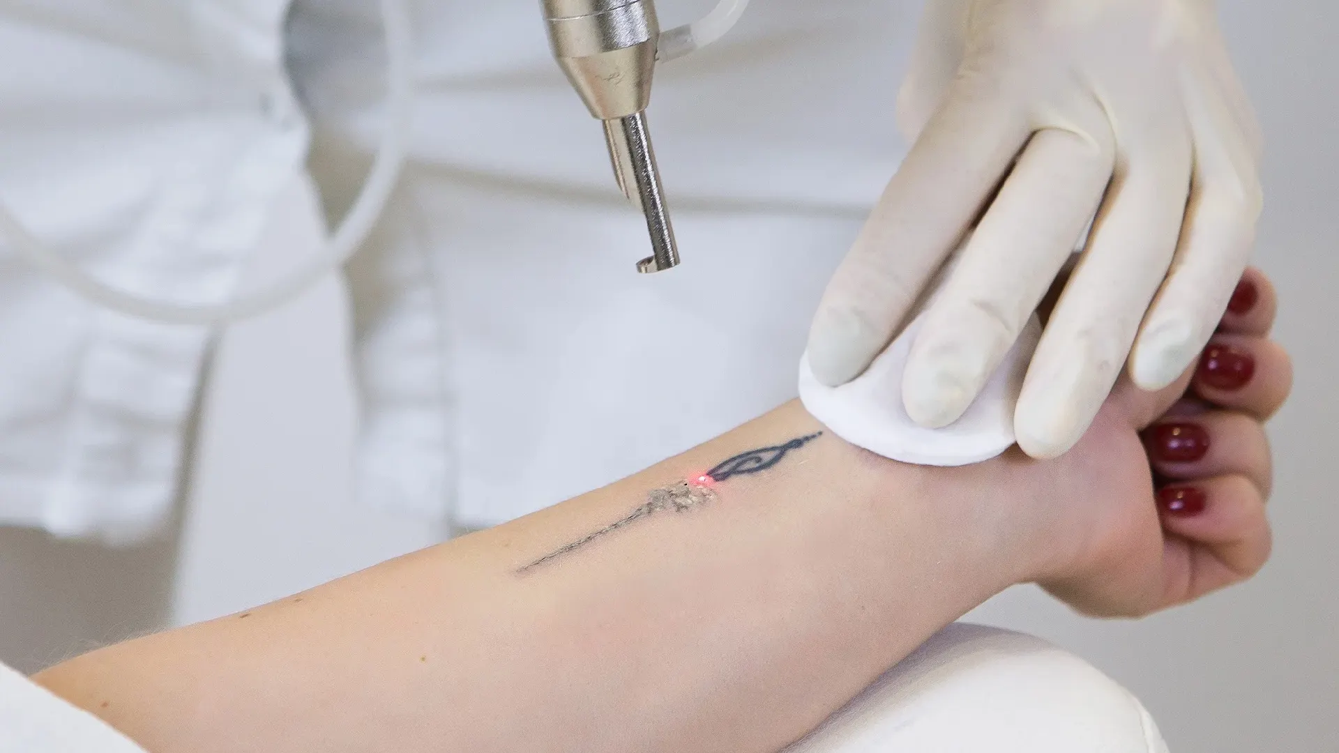 Laser tattoo removal on a wrist, with a small design being treated.