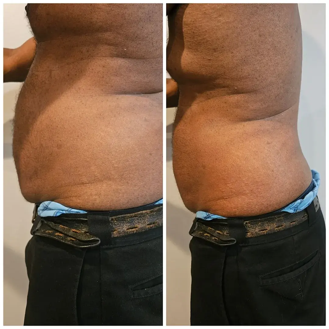 Cryo Slimming Before and After Image (4)
