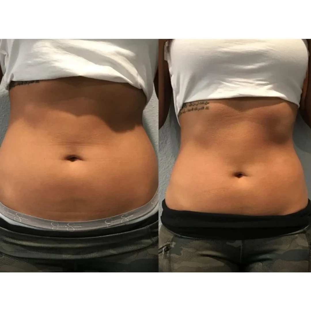 Cryo Slimming Before and After Image (3)