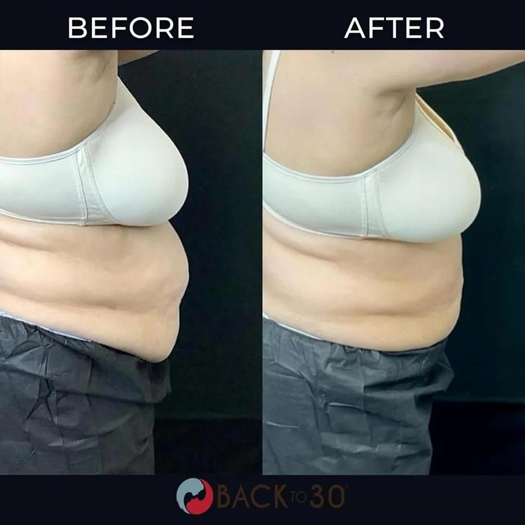 Cryo Slimming Before and After Image (6)