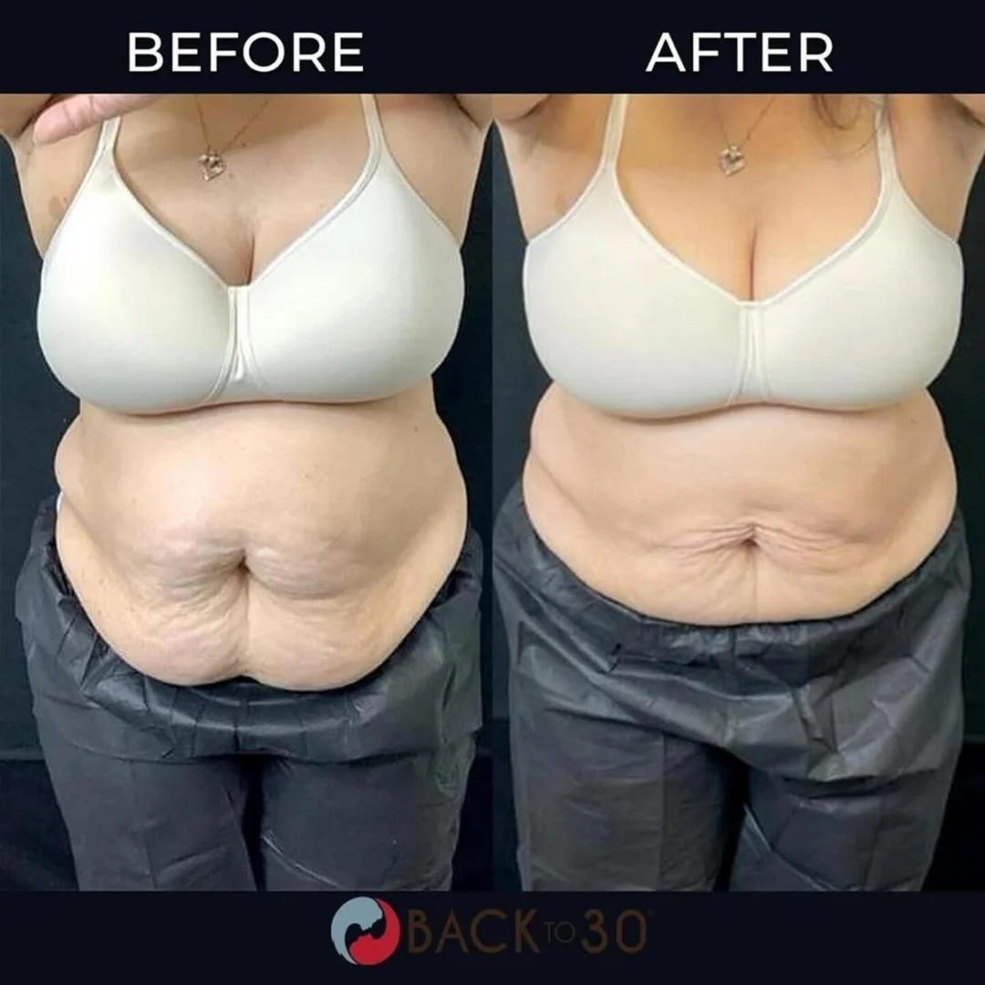 Cryo Slimming Before and After Image (7)