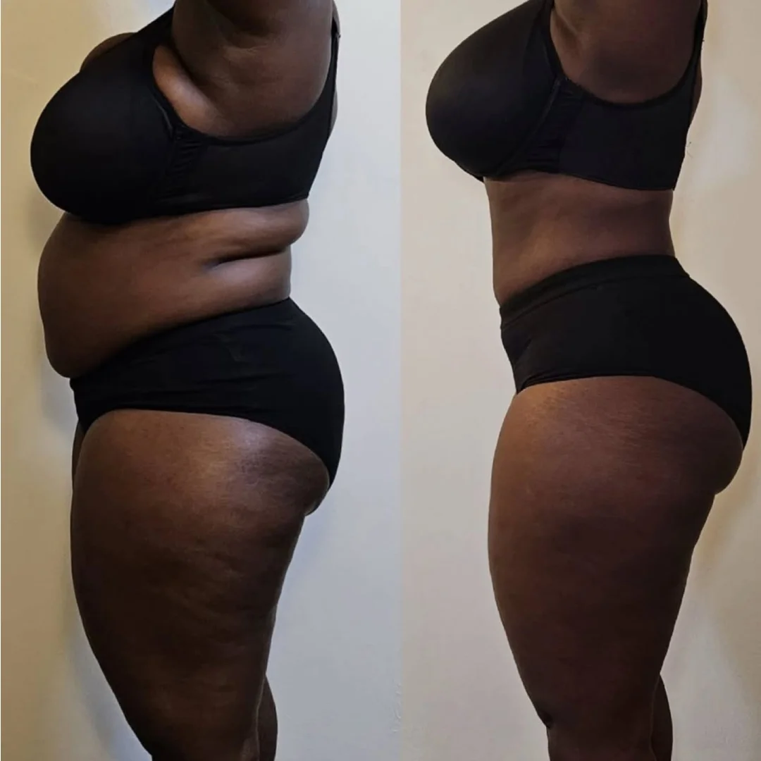 Cryo Slimming Before and After Image (2)