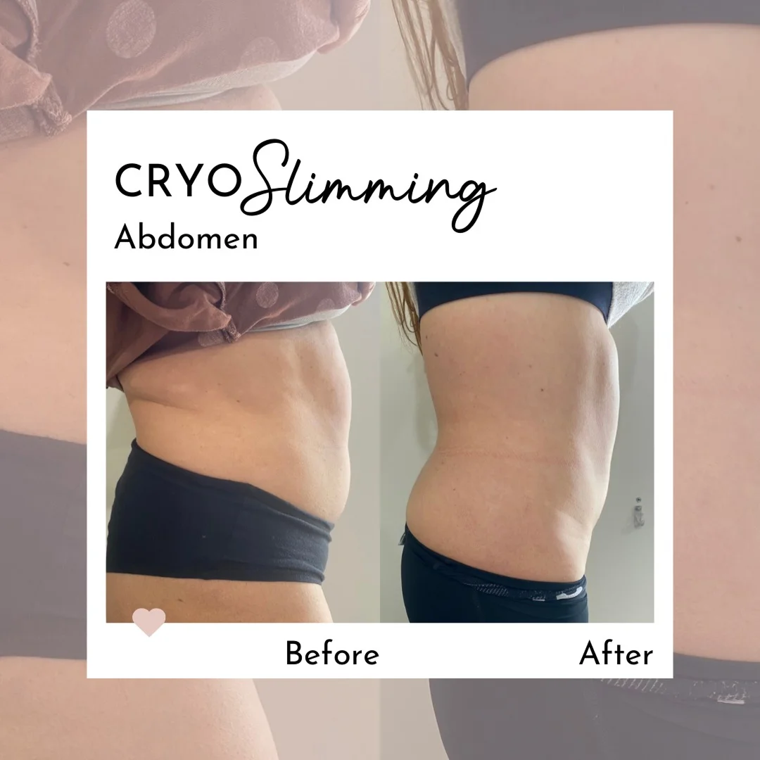 Cryo Slimming Before and After Image (10)