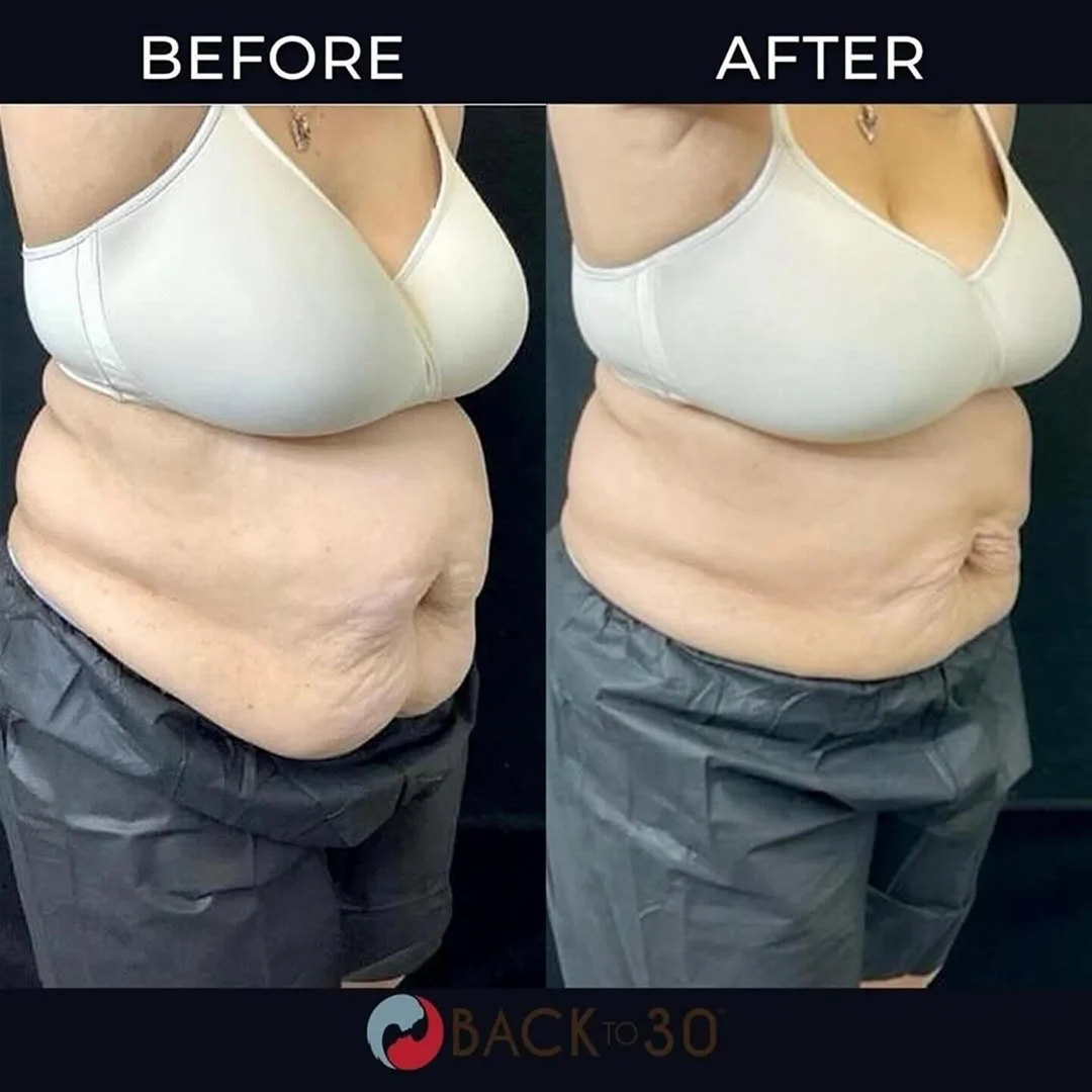 Cryo Slimming Before and After Image (5)