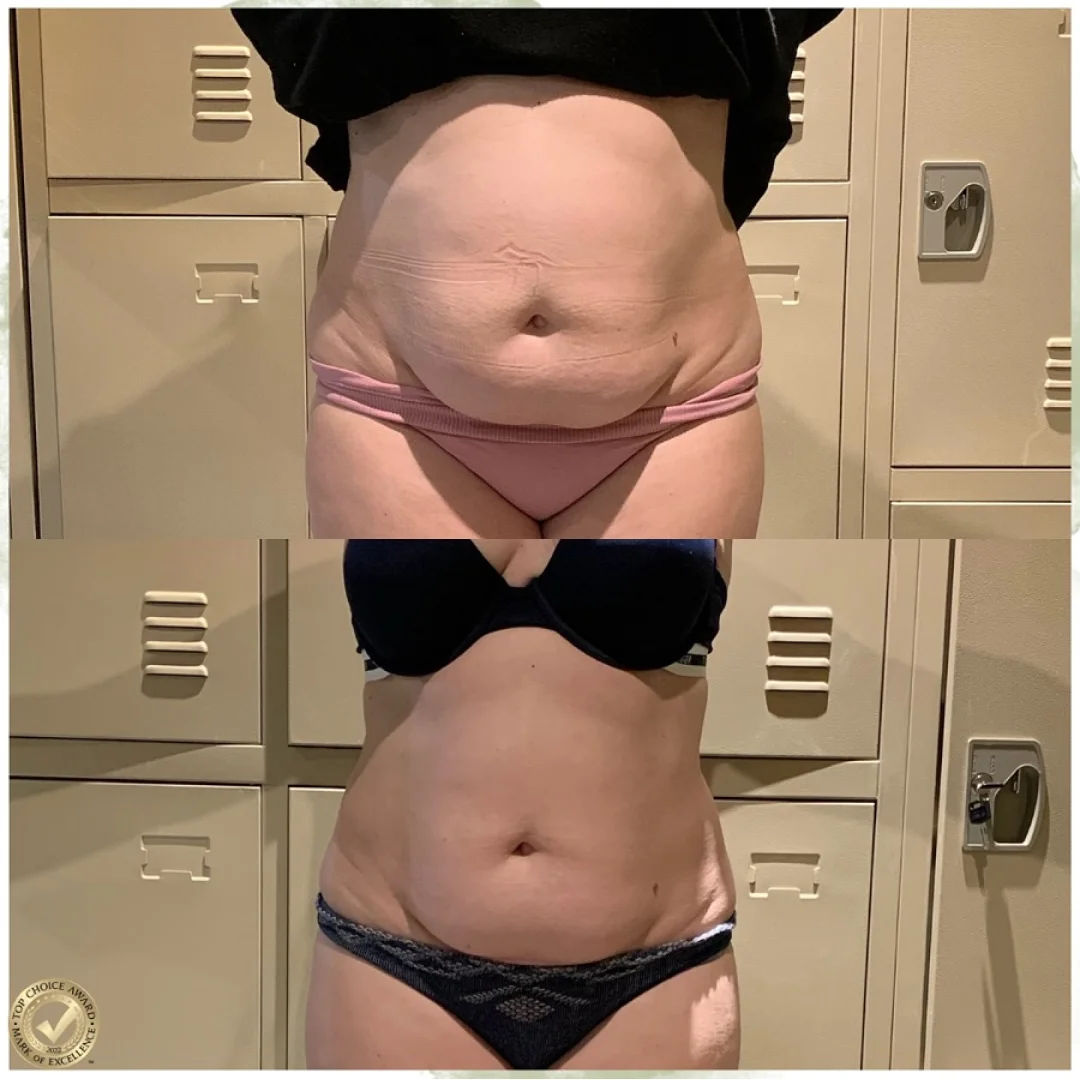 Cryo Slimming Before and After Image (1)