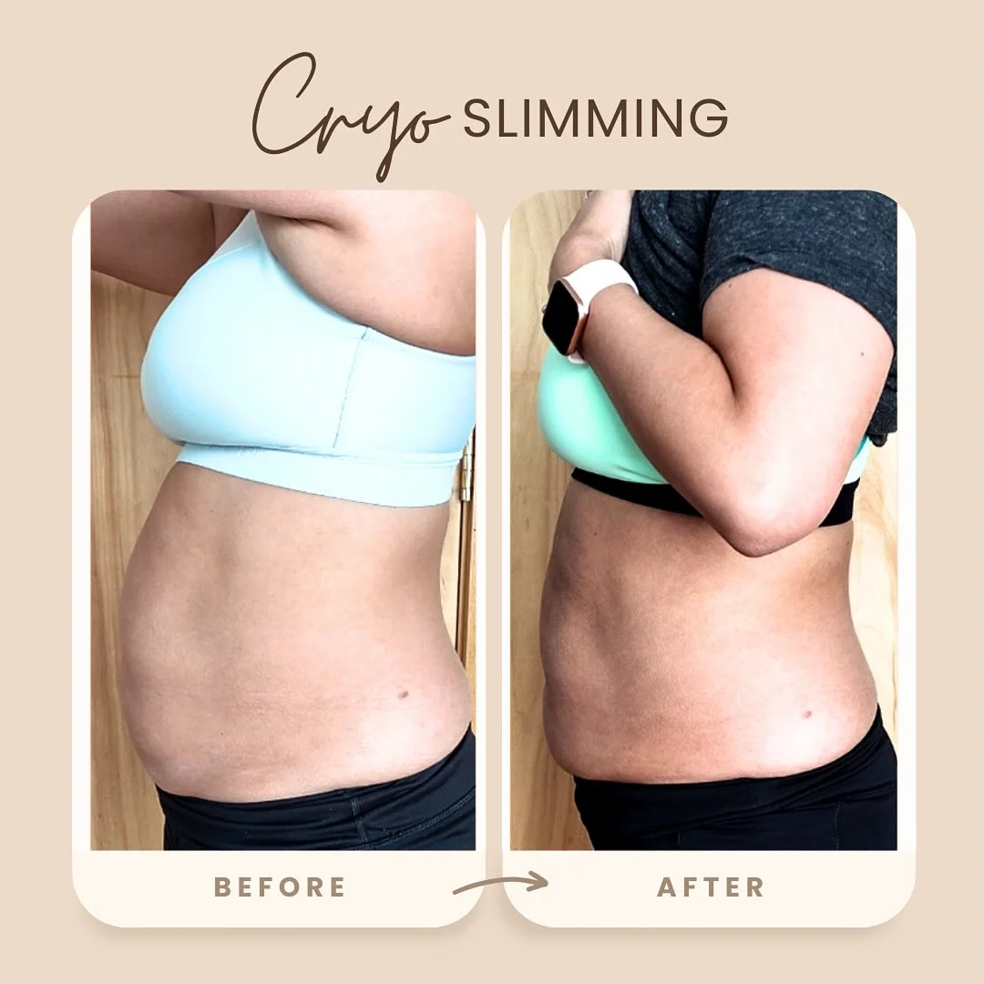Cryo Slimming Before and After Image (8)