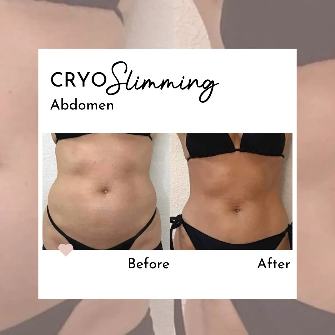 Cryo Slimming Before and After Image (9)
