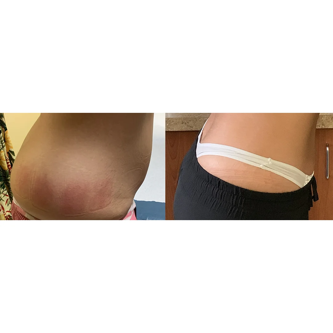 EvolveX Before and After image(2)