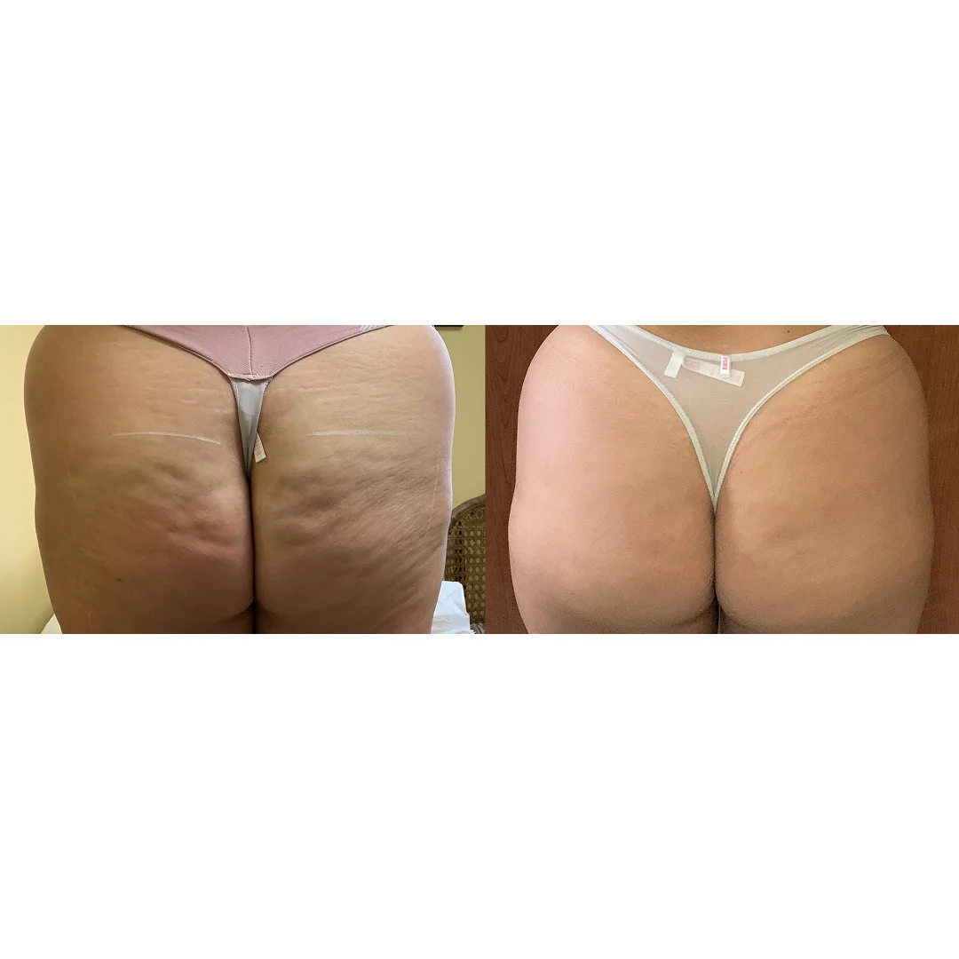 EvolveX Before and After image(3)