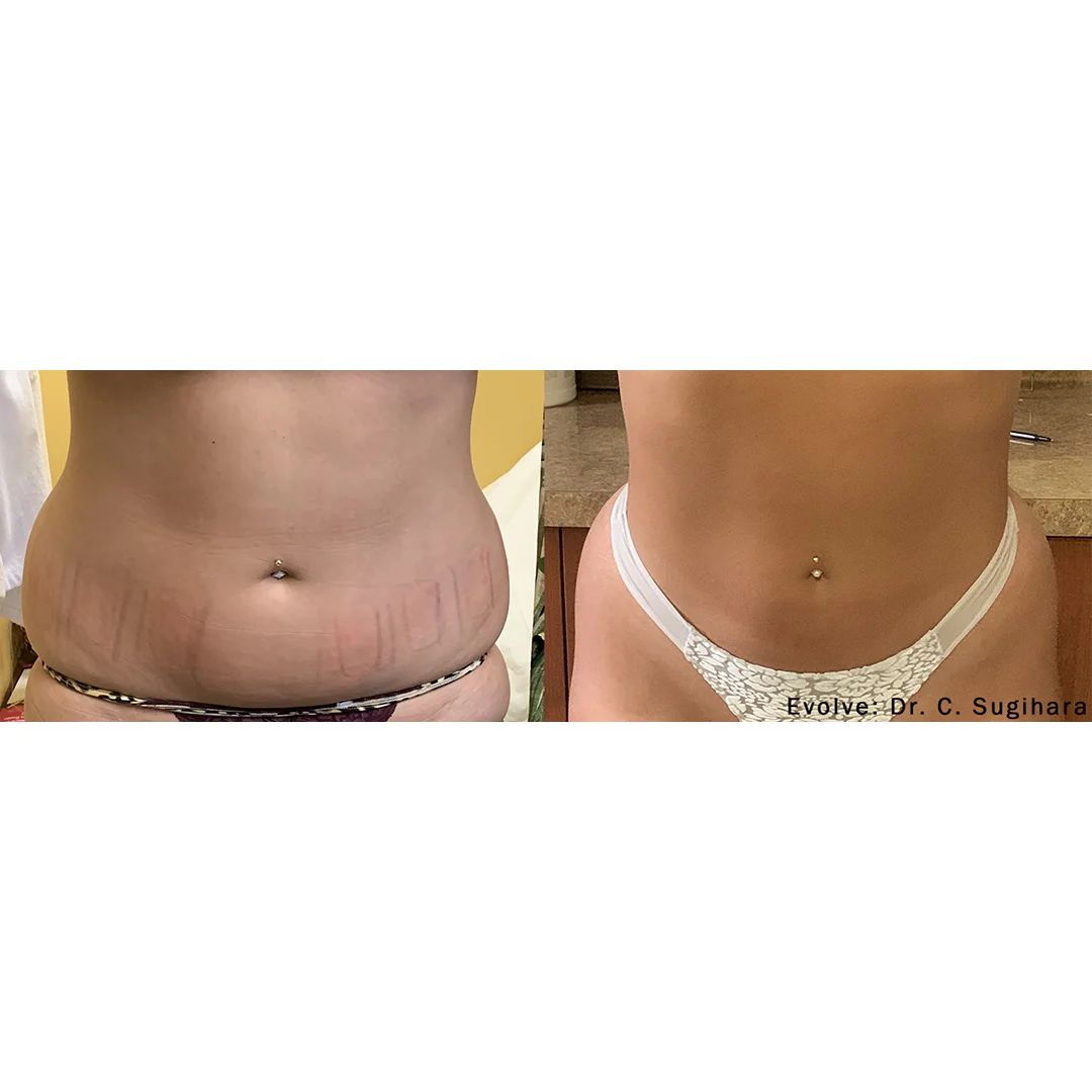 EvolveX Before and After image(6)