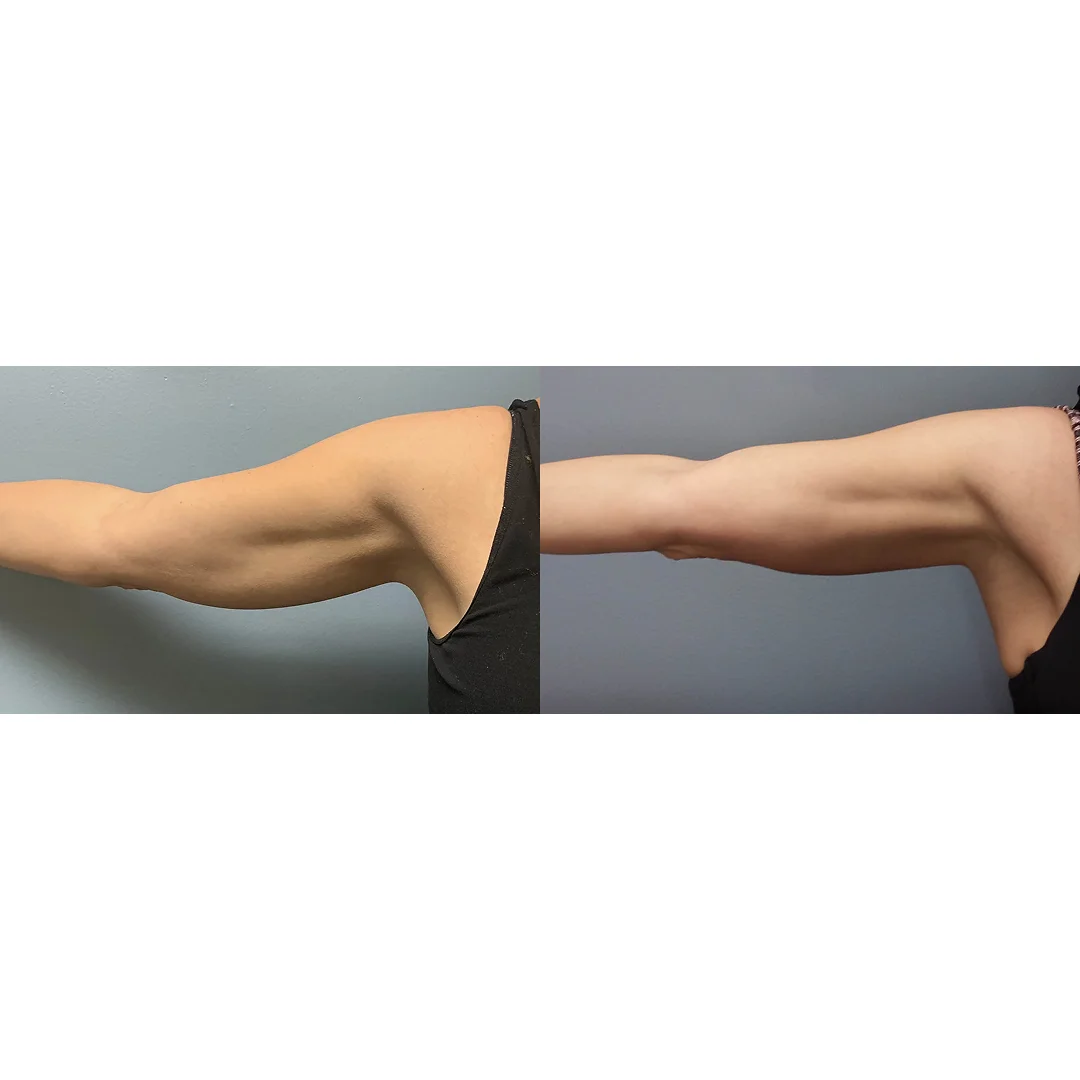 EvolveX Before and After image(1)