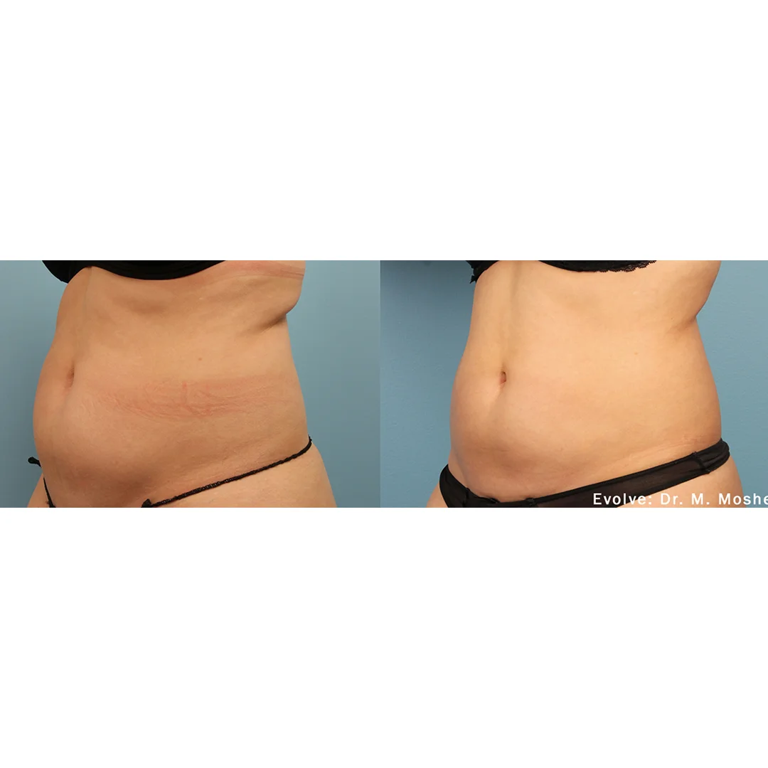 EvolveX Before and After image(4)