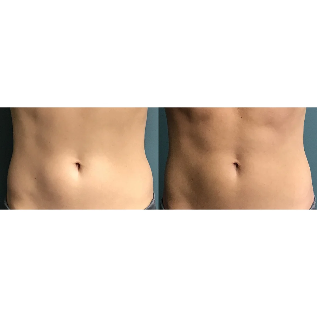 EvolveX Before and After image(5)