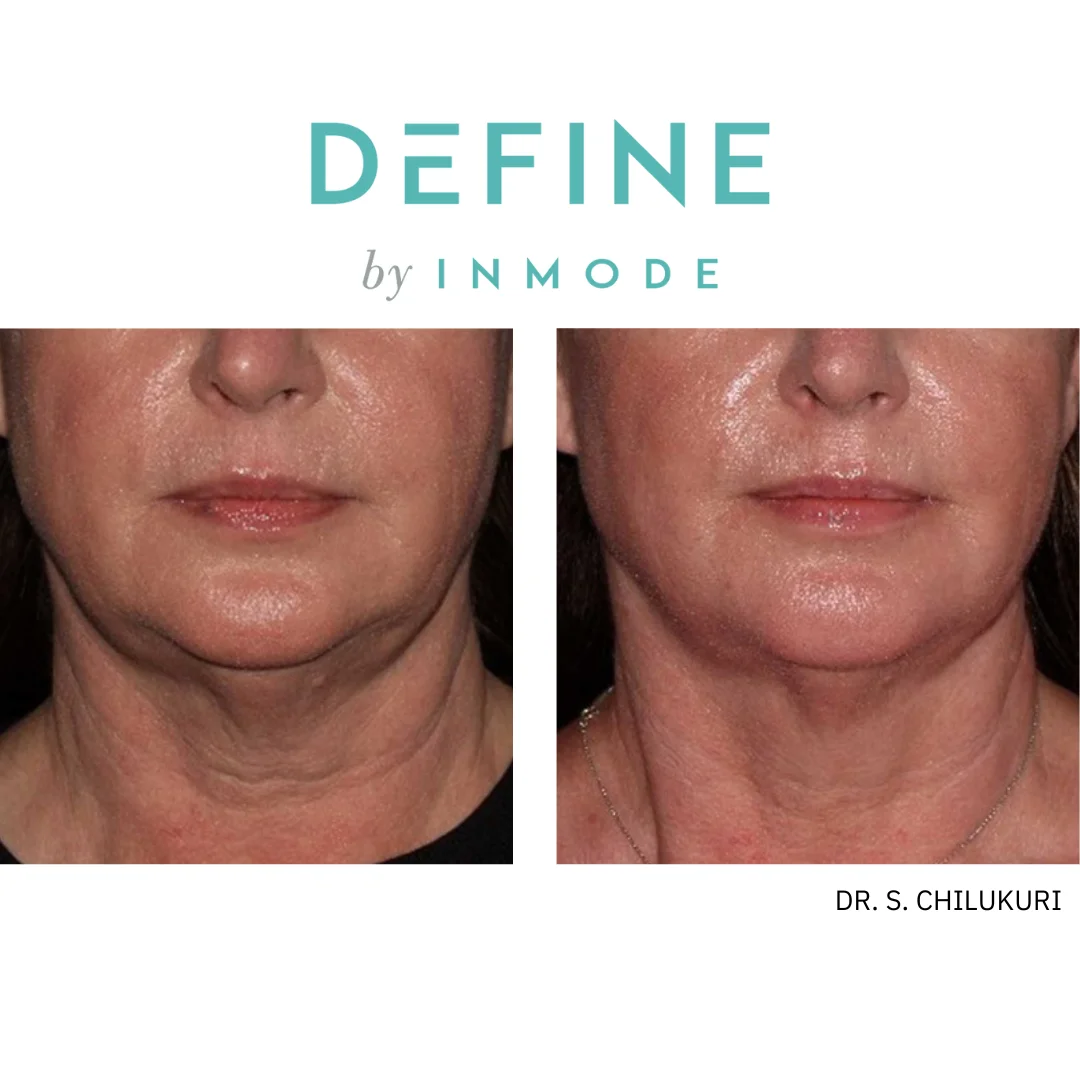 InMode Define Before and After Image (1)
