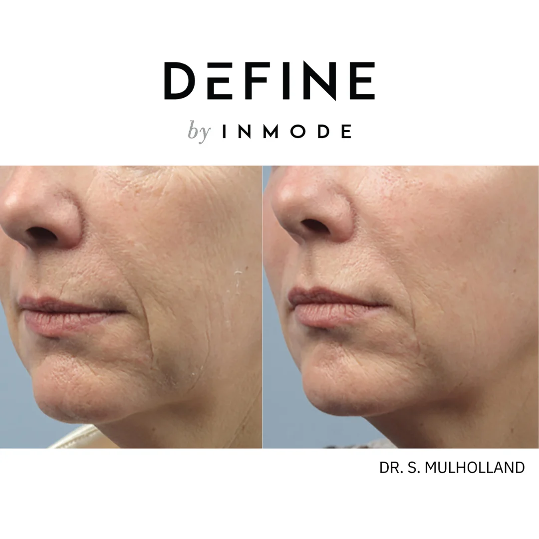 InMode Define Before and After Image (4)