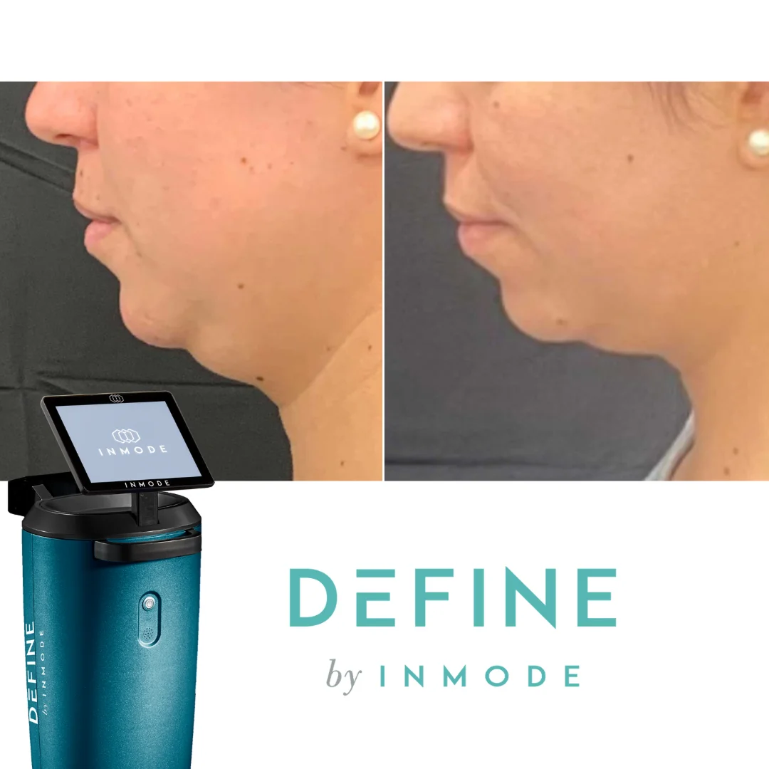 InMode Define Before and After Image (2)