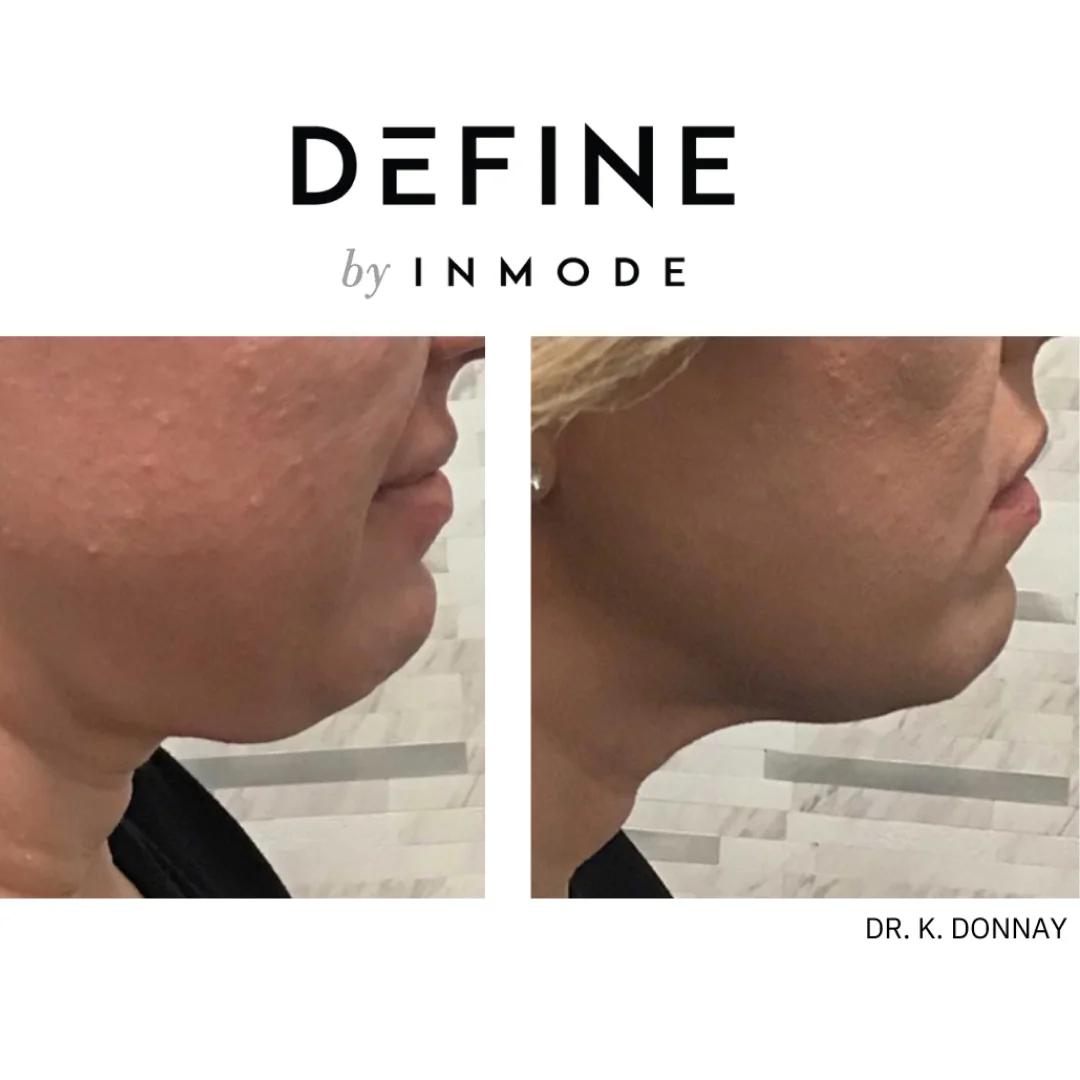 InMode Define Before and After Image (3)