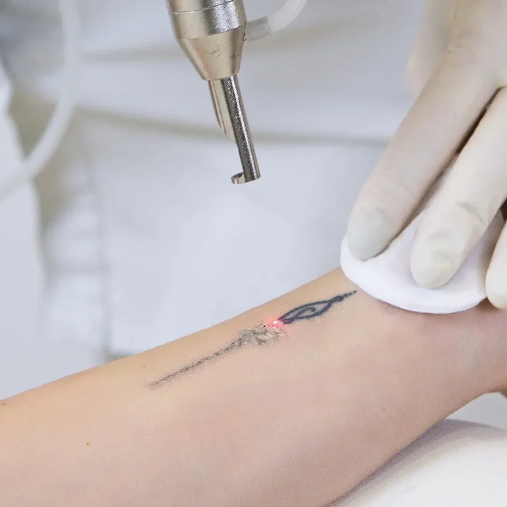 Laser tattoo removal on a wrist, with a small design being treated.